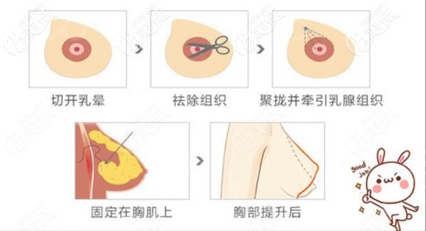 乳房雙環(huán)提升術(shù)操作過程示意圖