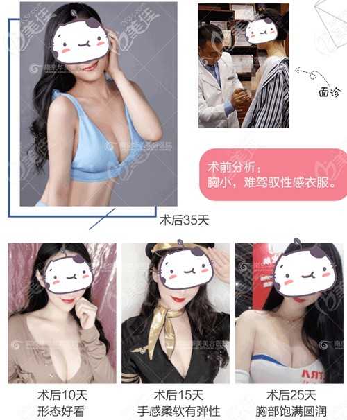 南京華美傲諾拉假體隆胸案例