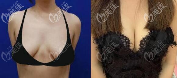 乳房雙環(huán)懸吊提升2年效果圖