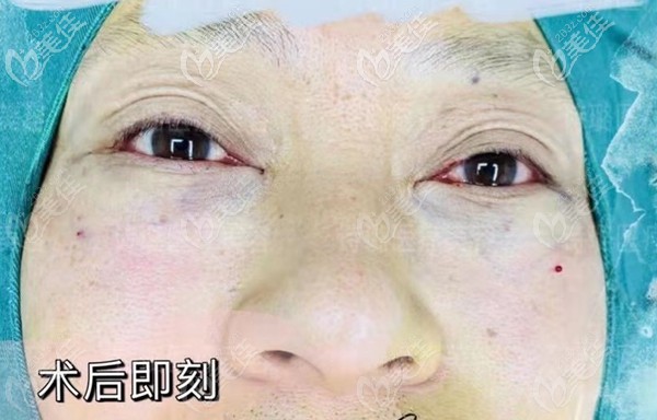 惠州詩(shī)璐醫(yī)療美容的一針無(wú)痕祛眼袋幫你“袋”走煩惱!