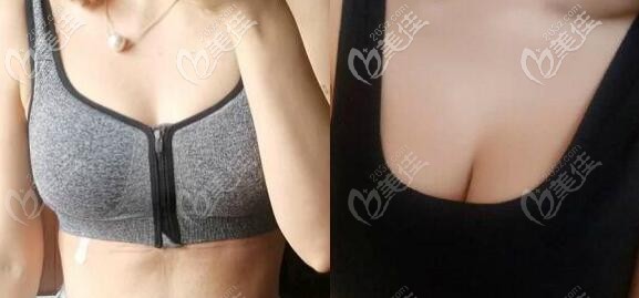 花苞提胸術(shù)效果前后對(duì)比