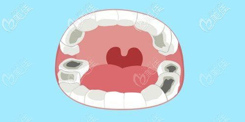 蛀牙牙齒有洞怎么辦