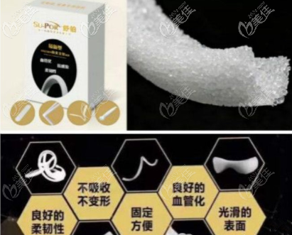 美國舒鉑鼻假體材料的優(yōu)點 美國舒鉑鼻假體材料的優(yōu)點