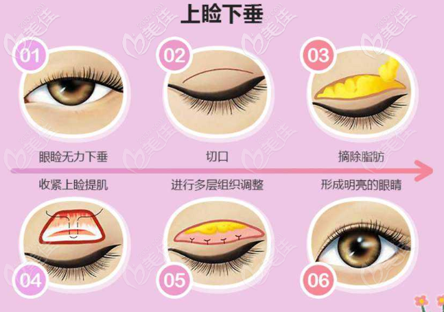 上瞼提肌縮短術(shù)操作圖解