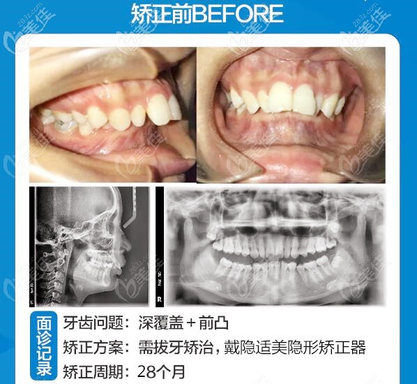 合肥貝杰口腔醫(yī)院臨泉路店牙齒矯正案例 合肥貝杰口腔醫(yī)院臨泉路店牙齒矯正案例