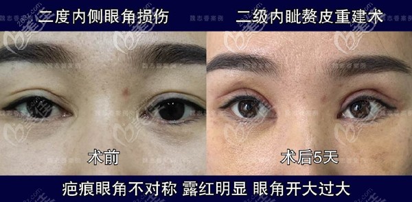 魏志香醫(yī)生開(kāi)眼角括號(hào)型疤痕修復(fù)對(duì)比