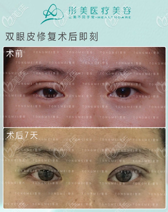 潘彥龍醫(yī)生凹陷性疤痕修復(fù)術(shù)后7天的反饋