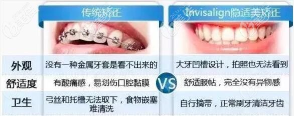 牙齒深覆合戴金屬和隱形牙套哪個(gè)好 牙齒深覆合戴金屬和隱形牙套哪個(gè)好
