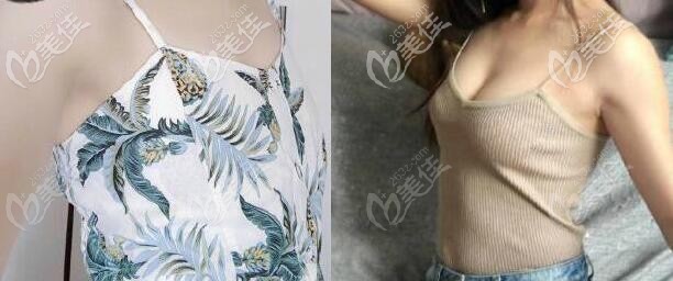 曼托水滴250cc假體隆胸一年效果圖片 曼托水滴250cc假體隆胸一年效果圖片