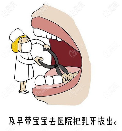 醫(yī)生建議拔除乳牙的原因