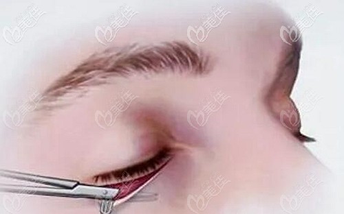 外眥懸吊手術(shù)的原理 外眥懸吊手術(shù)的原理