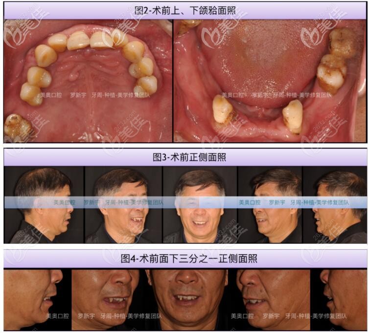 牙齒松動脫落術(shù)前樣子 牙齒松動脫落術(shù)前樣子