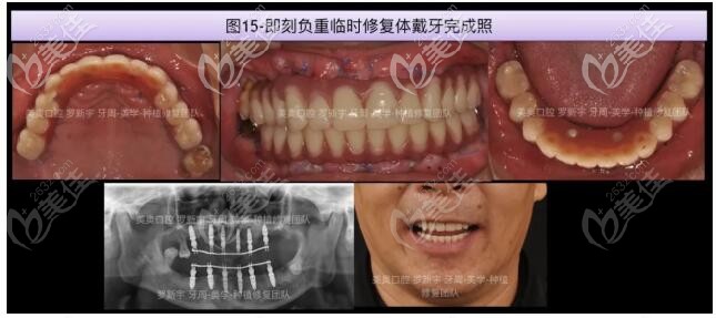 做過烤瓷牙的65歲大爺牙齒松動脫落，在常州美奧重新做了NOBEL諾貝爾全口即刻種植牙