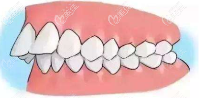 牙齒外突示意圖