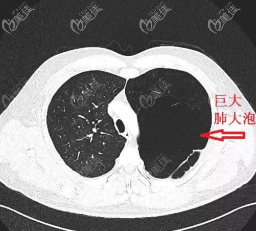 氣胸的表現(xiàn)
