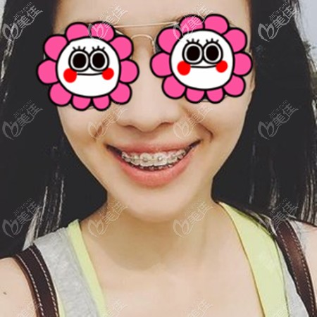 沒到鄭州唯美做ormco金屬自鎖托槽矯正牙齒前，我哪知道這還分品牌呢