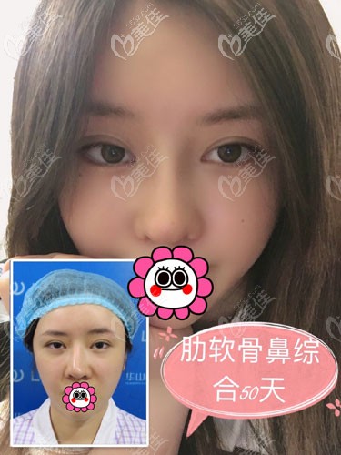 杭州連天美隆鼻技術好嗎？自從讓他給我做了肋軟骨鼻修復后我很滿意