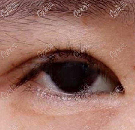 全切雙眼皮眼瞼外翻的癥狀