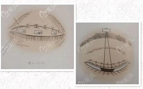 雙眼皮外翻露白的原因