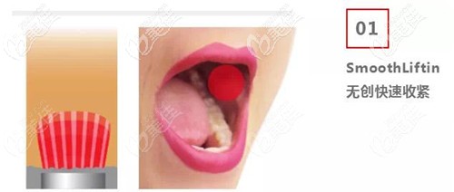 Fotona4D口內(nèi)模式 Fotona4D口內(nèi)模式