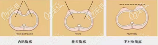 不同的胸部輪廓