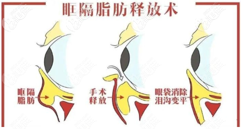 眶隔脂肪釋放術(shù)