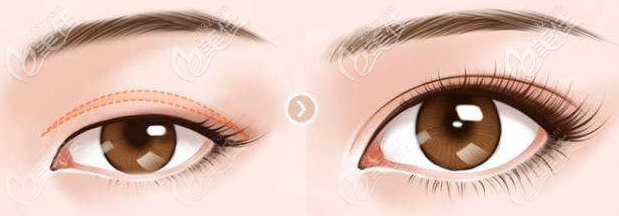 章沈云雙眼皮特點 章沈云雙眼皮特點