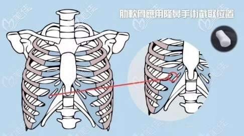 隆鼻全肋還是半肋好 隆鼻全肋還是半肋好