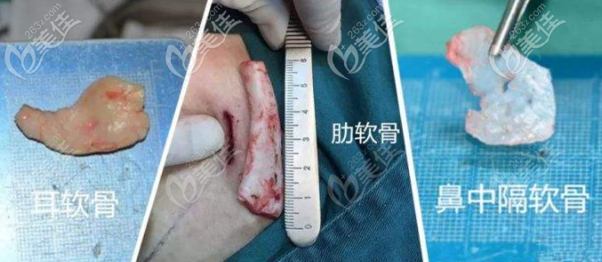 肋軟骨和耳軟骨哪個(gè)好