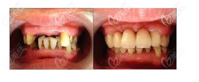 揭陽牙博士植牙實例