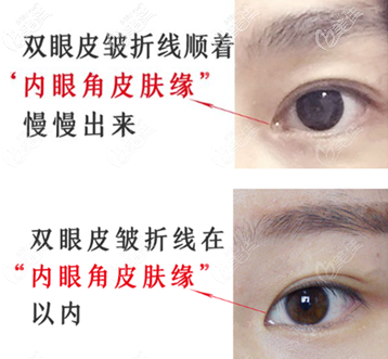 開扇形扇形雙眼皮哪個好看 開扇形扇形雙眼皮哪個好看