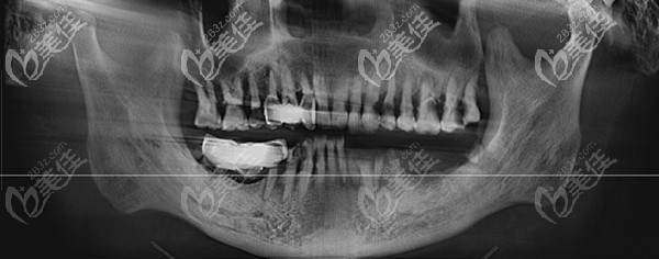術前下半口無牙