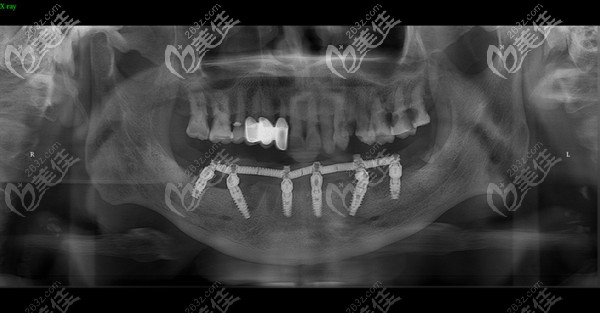 石家莊趙翠彩口腔做下頜all-on-6術后恢復正常