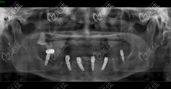 石家莊趙翠彩口腔做下頜all-on-6后恢復情況