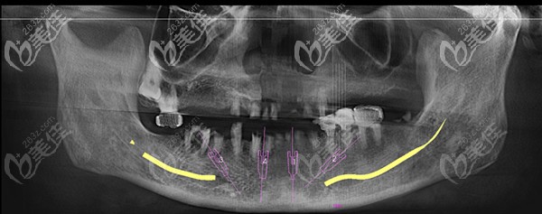 術前下頜牙齒缺失