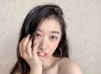 做完雙眼皮后一個(gè)月 做完雙眼皮后一個(gè)月