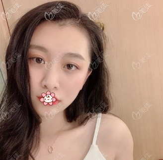 在重慶真熙美熙做完全切雙眼皮40天 在重慶真熙美熙做完全切雙眼皮40天