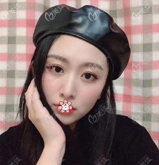 這回在重慶真熙美熙割的6mm全切雙眼皮寬度正合適