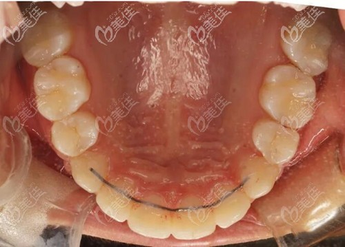 舌側(cè)矯正器