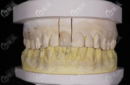 全瓷牙單冠效果