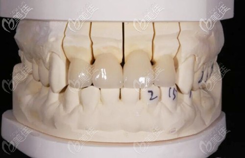 全瓷牙四連冠效果