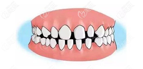 連冠牙和單冠感覺一樣嗎