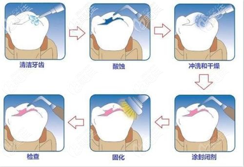 窩溝封閉的手術原理