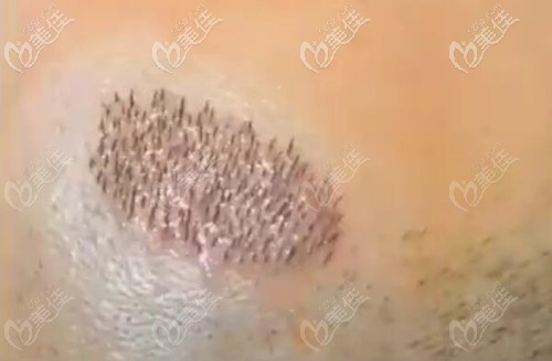 發(fā)際線種植200毛囊單位 發(fā)際線種植200毛囊單位