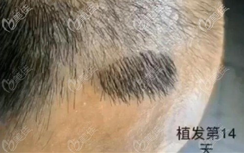 種植頭發(fā)200個毛囊單位有多大面積?多少錢?來西安沐森速倍植發(fā)看看吧!