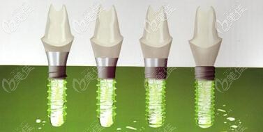 瑞士iti種植體 瑞士iti種植體