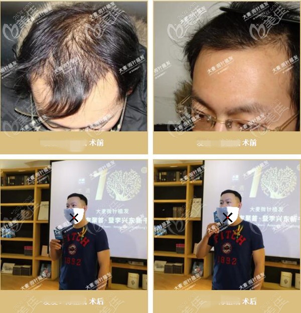 大麥微針植發(fā)頭頂稀疏加密植發(fā)<span style= 大麥微針植發(fā)頭頂稀疏加密植發(fā)<span style=