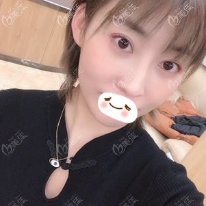 彭繼忠醫(yī)生做微創(chuàng)內(nèi)切祛眼袋案例：3個月后眼袋消失的同時臥蠶也更明顯了