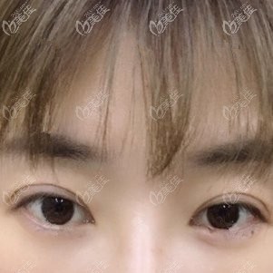 彭繼忠為我做內(nèi)切祛眼袋術后三天效果 彭繼忠為我做內(nèi)切祛眼袋術后三天效果