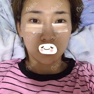 在<!--<i data=20240703-sp></i>-->剛割完眼袋后的樣子 在<!--<i data=20240703-sp></i>-->剛割完眼袋后的樣子